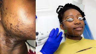 Laser Hair Removal Black Skin - PCOS Treatment Review London