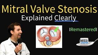 Mitral Valve Stenosis: Diagnosis, Treatment, Pathophysiology