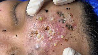 Big Cystic Acne Blackheads Extraction Blackheads & Milia, Whiteheads Removal Pimple Popping # 1608