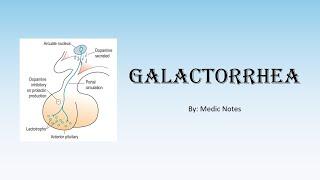 Causes & pathophysiology of galactorrhea, prolactinoma, pituitary stalk compression, hypothyroidism