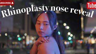 Worth it ba? Nose Reveal/Best Doctor in the Philippines /Rhinoplasty Journey -Doc Joyce Regalado