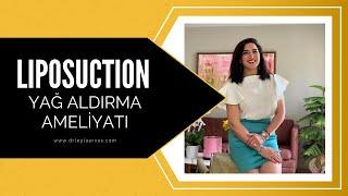 Liposuction (Liposakşın) | Yağ Aldırma Ameliyatı | Op. Dr. Leyla Arvas