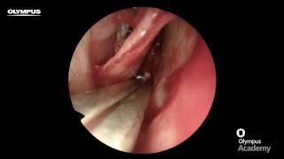 Olympus Academy – 4K ENT Surgery, Endoscopic Septoplasty - Professor Simon Carney