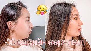 30өдрийн дараа  (асуулт &хариулт)  My plastic surgery in korea pt4