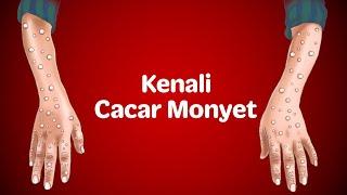 Kenali Cacar Monyet