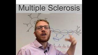 Multiple Sclerosis