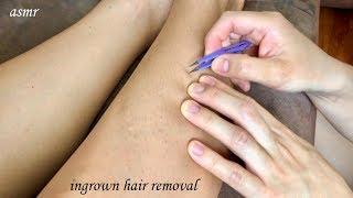 ASMR Leg Check! Ingrown Leg Hair Removal w. a Tweezer!! Leg Scanning is SOOO RELAXING!! 