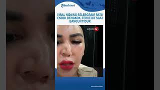 Viral Hidung Selebgram Ratu Entok Bengkok, Terkejut Saat Bangun Tidur