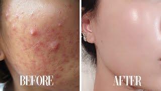Get CLEAR SKIN subliminal | Get rid of acne in 10 minutes!