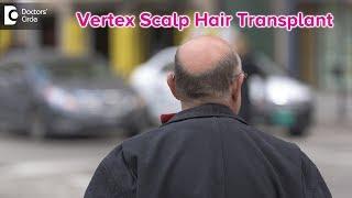 When should vertex area of the scalp be transplanted? - Dr. Niranjana Raj