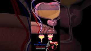 BPH - Benign prostatic enlargement - 3D Animation - Urine Retention