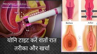 बिना सर्जरी योनि टाइट करने का तरीका और खर्चा। Without Surgery Vaginal Tightening Methods and Cost