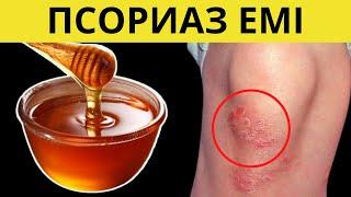 Псориаз емдеу жолдары. Псориаз ТЕЗ кету үшін осы ЗАТТЫ жасаңыз