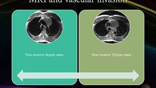 Thymoma