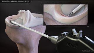 FiberStitch™ All-Inside Meniscus Repair