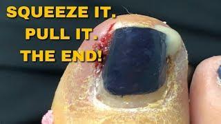 Squeeze It, Pull It, The End. Ingrown Toenail Removal.