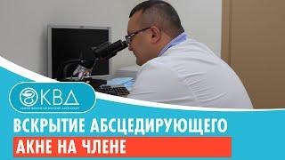  Вскрытие абсцедирующего акне на члене. Клинический случай №188