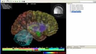 Tutorial: Brain Explorer® 3-D Viewer for the Allen Human Brain Atlas