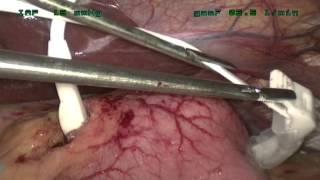 Magenband OP, Lehrvideo / Educational:  / Gastric band surgery