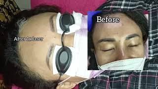 Laser Sulam Alis Part 2 || Gagal Sulam Dari Tempat Lain