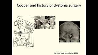 CNS Neurosurgery 100: Neurosurgery for Dystonias