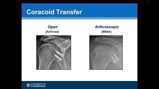 Rocky Mountain Shoulder 2024: Open Coracoid Transfer: Double Suture-Button Fixation