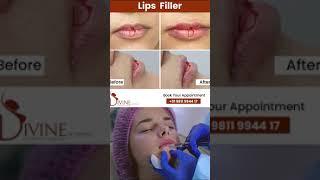 Lip Filler Results | Lip Filler Before After Photos