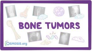 Bone tumors - causes, symptoms, diagnosis, treatment, pathology