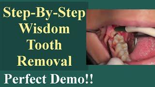 Extraction Procedure Of Horizontal Impacted Right 3rd Molar Tooth|Step-By-Step Wisdom Tooth Removal