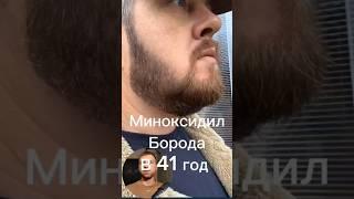 Миноксидил результаты в 41 год