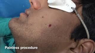 Mole Removal By Radiofrequency Ablation l Bliniq Cosmetic Surgery Centre I Dr Ashwani Kumar