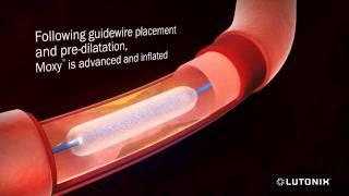 Angioplasty for Restenosis with Paclitaxel 3D Animation