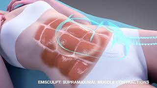 EMSculpt® Abdominal Body Contouring NYC