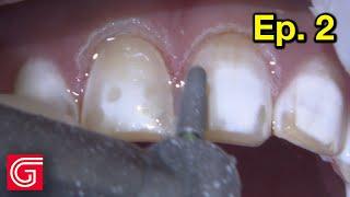 How To Prepare ANTERIOR Teeth With ENAMEL Hypoplasia | Ep 2