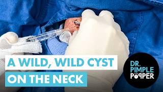 A Wild, Wild Cyst on the Neck