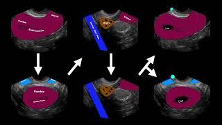 POCUS: 1st Trimester Pregnancy -  Case 5 - Complex adnexal mass