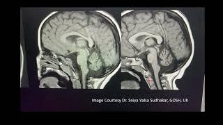 Hind brain for Radiologists-part 2