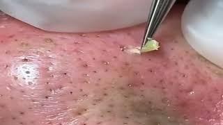 #shorts Huge Blackheads Removal with a Tweezer 01