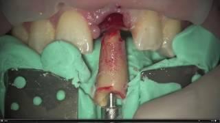 Dental Excellence 17: Root Extraction System.