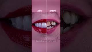 The difference a little  can make  #Shorts #tiktok #new #smile | Before&After Dental Implants