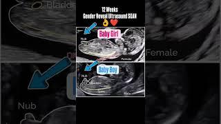 12 Week's Gender Reveal Ultrasound Scan #genderpredictions #genderdetermination #genderreveal