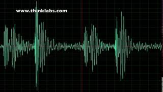 Aortic Stenosis