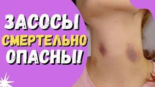 Чем опасны засосы? Будьте осторожны!