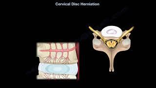Cervical Disc Herniation What Is The Intervertebral Disc? what is a disc herniation.