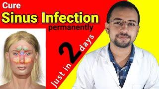 Cure sinus infection just in 2 days naturally | Sinusitis treatment home tips | sinus symptoms