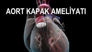 KALP KAPAĞI AMELİYATI | Aort Kapak Ameliyatı