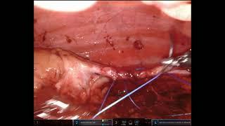 Right sided robotic flank hernia repair