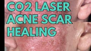 3 things to help CO2 laser healing for acne scars