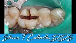 Sectioning and Extraction of Maxilary First Molar - with Steven T. Cutbirth, DDS