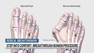 Step into comfort: Breakthrough bunion procedure